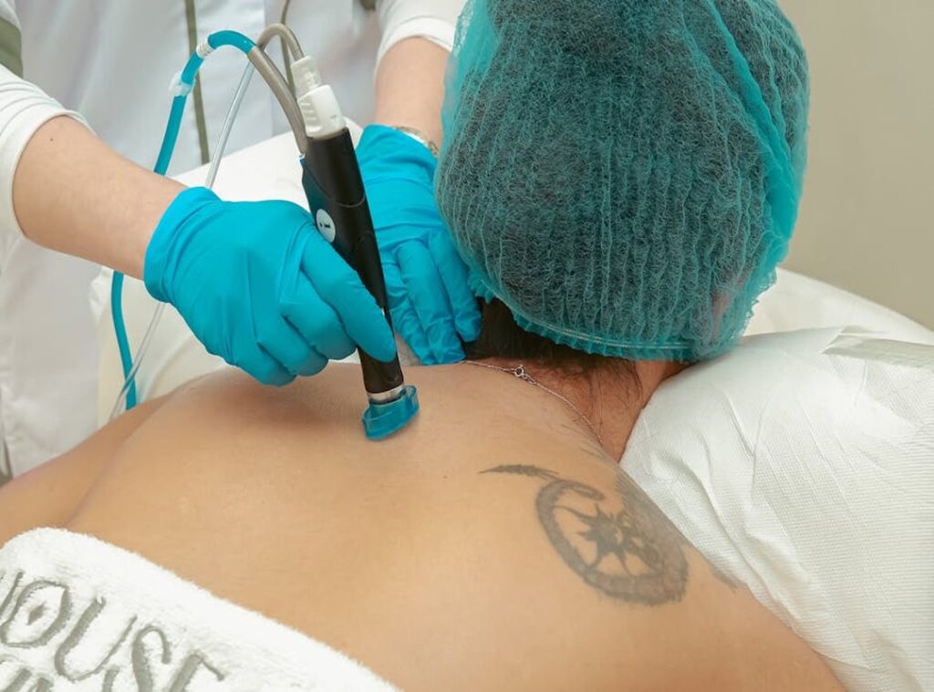 Which Is the Procedure in Tattoo Removal Altwayguides